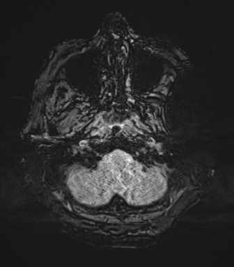 Basal ganglia metastasis (Radiopaedia 78928-91828 Axial SWI 7).png