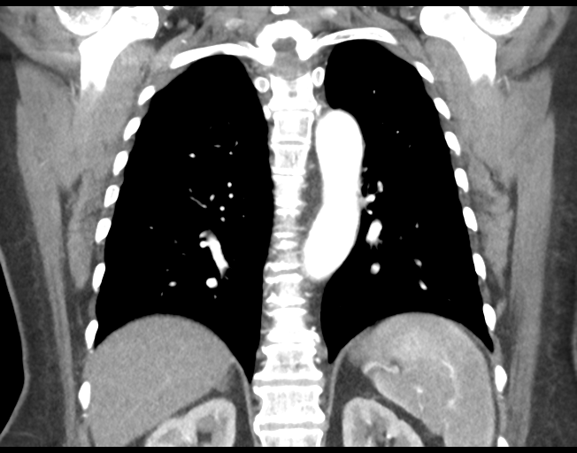 Basal ganglia metastasis (Radiopaedia 78928-91832 C 36).png