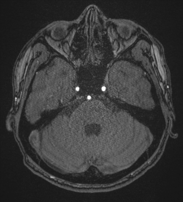 Basal ganglia subacute infarct (Radiopaedia 80201-93521 Axial MRA 23).png