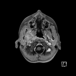 Base of skull rhabdomyosarcoma (Radiopaedia 32196-33142 T1 C+ fat sat 21).jpg