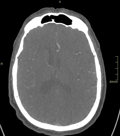 Basilar artery aneurysm (Radiopaedia 56261-62932 A 89).jpg