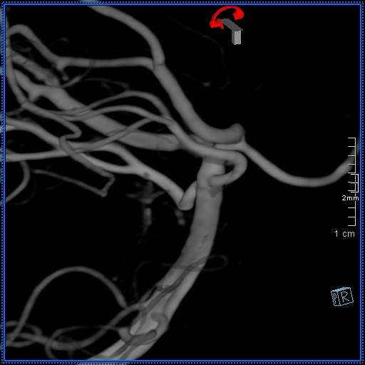 Basilar artery perforator aneurysm (Radiopaedia 82455-99524 3D Left VA 71).jpg