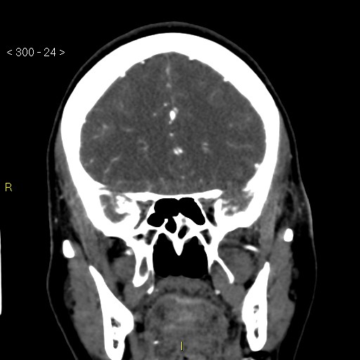 Basilar artery thrombosis (Radiopaedia 16260-15944 B 15).jpg