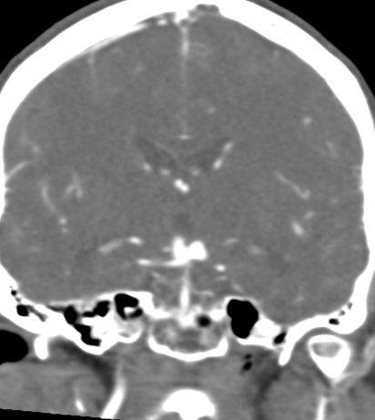 Basilar tip aneurysm with coiling (Radiopaedia 53912-60086 B 77).jpg