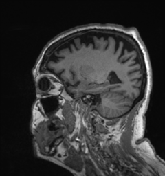 File:Behavioral variant frontotemporal dementia and late onset schizophrenia (Radiopaedia 52197-58083 Sagittal T1 74).png