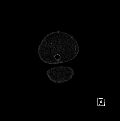 Below filter IVC thrombosis (Radiopaedia 58187-65266 B 7).jpg