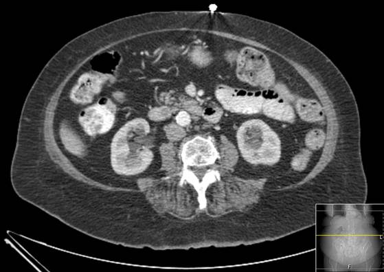 File:Bicameral celiacomesenteric aneurysm (Radiopaedia 55766-62327 A 32).jpg