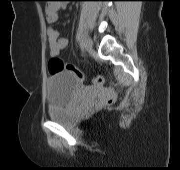 File:Bicornuate uterus (MRI) (Radiopaedia 49206-54296 Sagittal 6).png