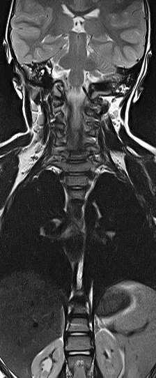 File:Bilateral Sprengel deformity with Klippel-Feil syndrome (Radiopaedia 66395-75650 F 4).jpg