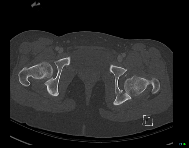 Bilateral acetabular fractures (Radiopaedia 79272-92308 Axial bone window 51).jpg