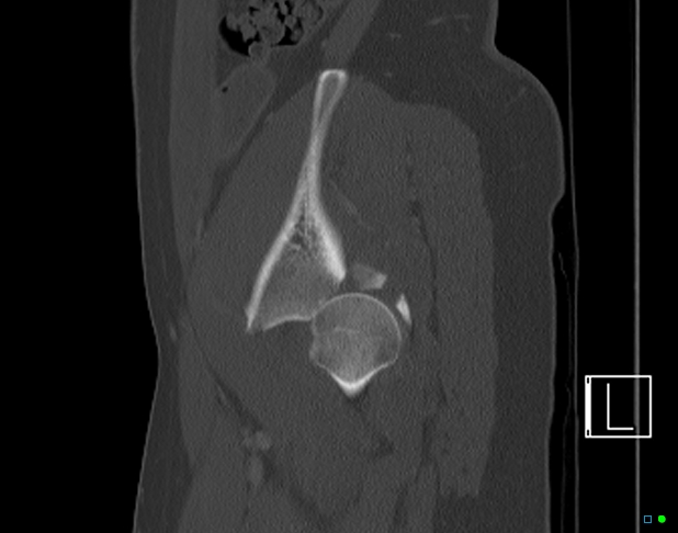 Bilateral acetabular fractures (Radiopaedia 79272-92308 Sagittal bone window 71).jpg
