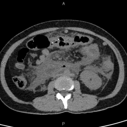 Bilateral adrenal gland hyperenhancement in pancreatitis (Radiopaedia 86642-102753 Axial non-contrast 58).jpg