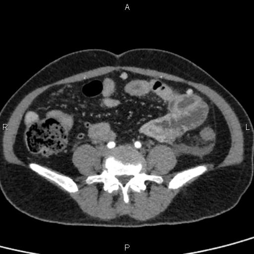 File:Bilateral adrenal gland hyperenhancement in pancreatitis (Radiopaedia 86642-102753 B 90).jpg