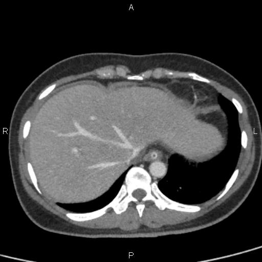 Bilateral adrenal gland hyperenhancement in pancreatitis (Radiopaedia 86642-102753 E 12).jpg