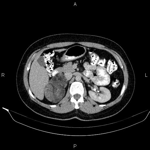 Bilateral adrenal myelolipoma (Radiopaedia 63058-71535 Axial C+ delayed 40).jpg
