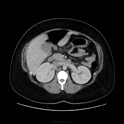 Bilateral adrenal thrombosis (Radiopaedia 58182-65256 A 27).jpg