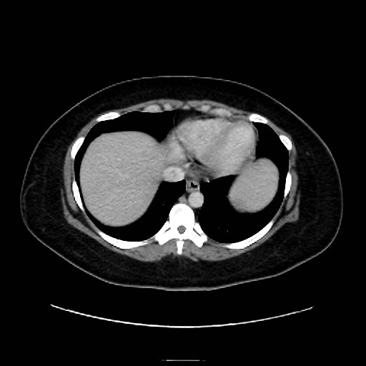 Bilateral adrenal thrombosis (Radiopaedia 58182-65256 A 4).jpg