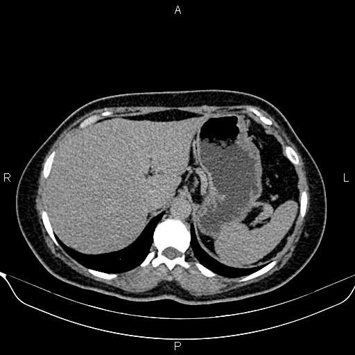 Bilateral benign adrenal adenomas (Radiopaedia 86912-103124 Axial C+ delayed 17).jpg