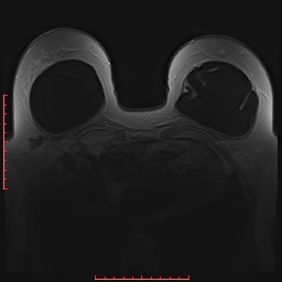 File:Bilateral breast implant rupture (Radiopaedia 24761-25027 PASTA 16).jpg