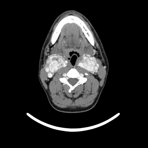 Bilateral carotid body tumors (Radiopaedia 52899-58827 A 14).jpg