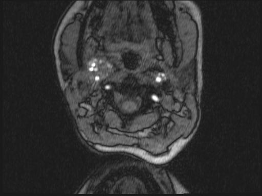 Bilateral carotid body tumors and right glomus jugulare tumor (Radiopaedia 20024-20060 Axial MRA 272).jpg