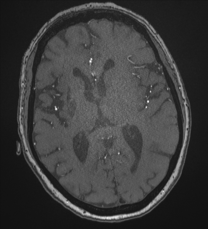Bilateral fetal posterior communicating arteries (Radiopaedia 41286-44102 Axial MRA 118).png