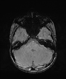 Bilateral mesial temporal polymicrogyria (Radiopaedia 76456-88181 Axial SWI 14).jpg
