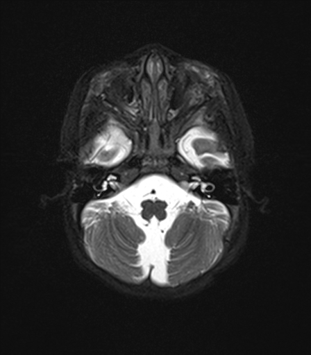 File:Bilateral optic pathway gliomas (Radiopaedia 40013-42514 Axial T2 fat sat 1).jpg