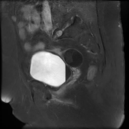 File:Bilateral ovarian dermoid cysts (Radiopaedia 90152-107338 Sagittal T1 C+ 9).jpg