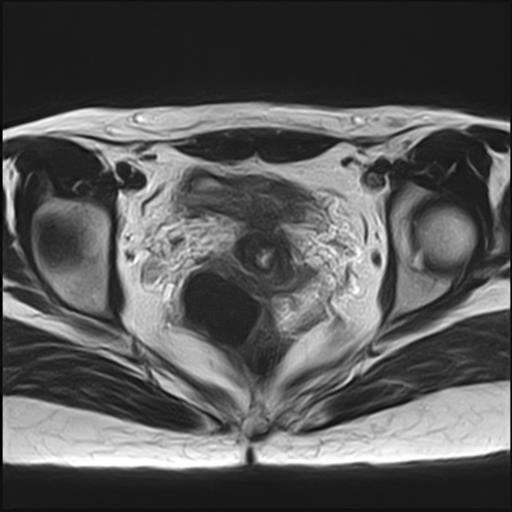 File:Bilateral ovarian endometriomas (Radiopaedia 87085-103347 Axial T2 14).jpg
