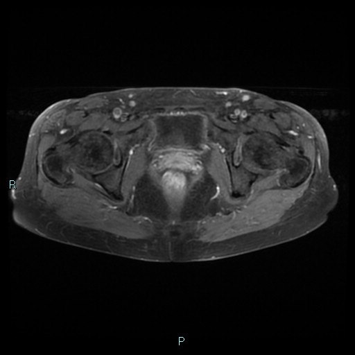 File:Bilateral ovarian fibroma (Radiopaedia 44568-48293 Axial T1 C+ fat sat 23).jpg