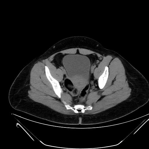 Bilateral ovarian mature cystic teratomas (Radiopaedia 79373-92457 Axial non-contrast 65).jpg