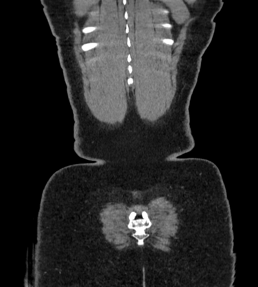 Bilateral ovarian mature cystic teratomas (Radiopaedia 79373-92457 B 108).jpg