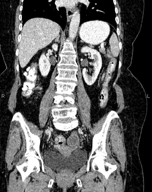 Bilateral ovarian serous cystadenocarcinoma (Radiopaedia 86062-101989 D 30).jpg