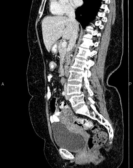 Bilateral ovarian serous cystadenocarcinoma (Radiopaedia 86062-101989 E 38).jpg