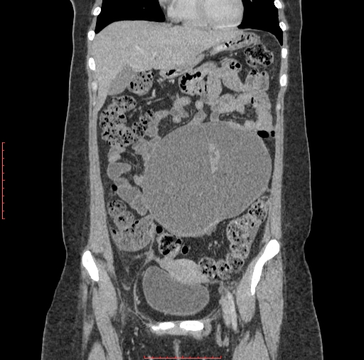 File:Bilateral ovarian serous cystadenocarcinoma with right ovarian torsion (Radiopaedia 32640-33611 B 11).jpg