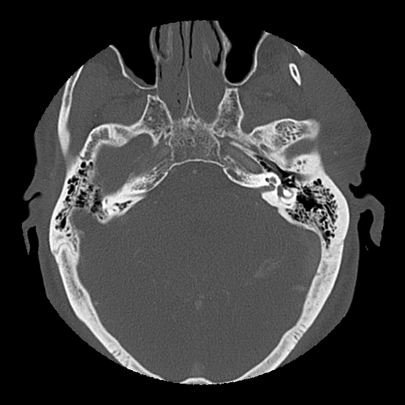 Bilateral perched facets with cord injury (Radiopaedia 45587-49713 Axial bone window 4).jpg