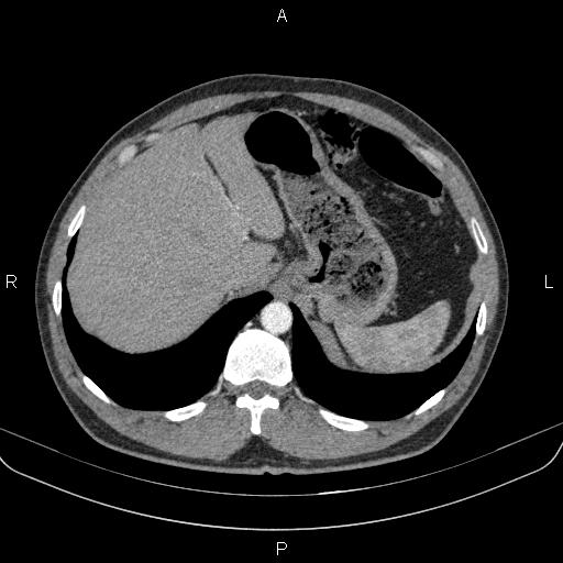 Bilateral pulmonary AVM (Radiopaedia 83134-97505 A 68).jpg