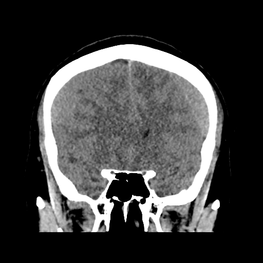 Bilateral subacute subdural hematoma (Radiopaedia 69240-79018 Coronal non-contrast 20).jpg