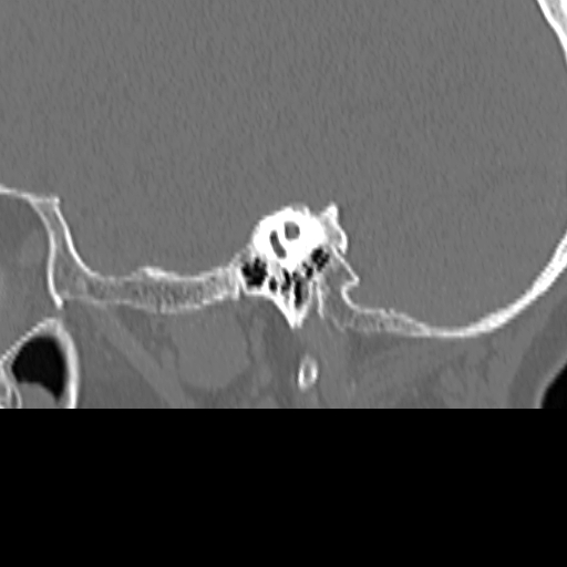 Bilateral tympanoplasty (Radiopaedia 16947-16664 Sagittal bone window 44).jpg