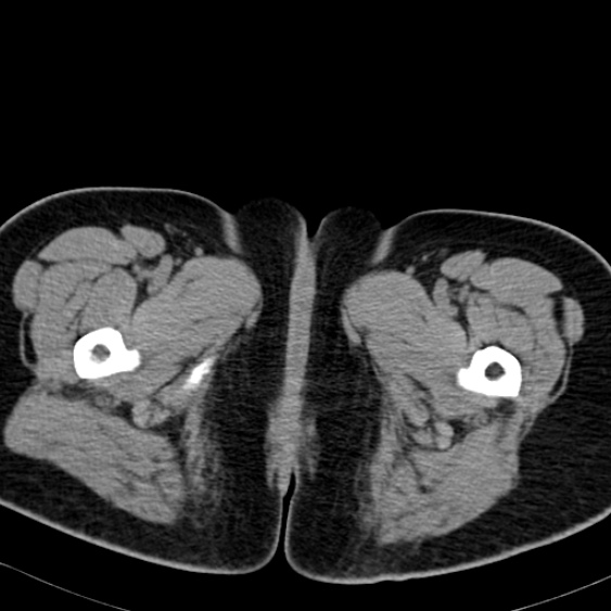 Bilateral ureteric stents (Radiopaedia 48795-53825 Axial non-contrast 77).jpg