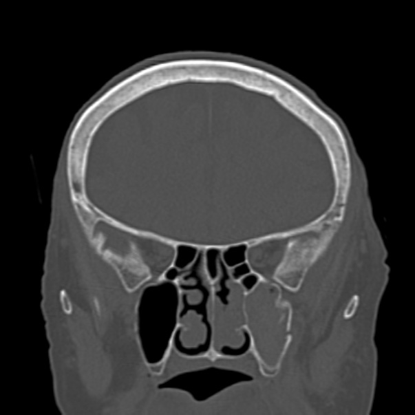 Biparietal osteodystrophy (Radiopaedia 46109-50463 Coronal bone window 36).jpg