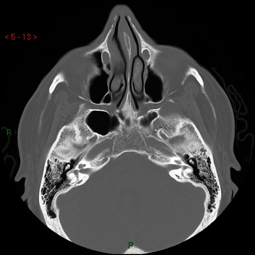 File:Bisphosphonate-related osteonecrosis of the jaw (Radiopaedia 54147-60329 Axial bone window 7).jpg