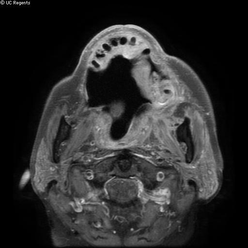 Bisphosphonate-related osteonecrosis of the maxilla (Radiopaedia 51367-57101 Axial T1 C+ fat sat 16).jpg