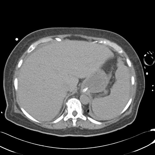 Bladder rupture post renal biopsy (Radiopaedia 30863-31572 Axial non-contrast 17).jpg