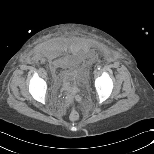 Bladder rupture post renal biopsy (Radiopaedia 30863-31572 Axial non-contrast 78).jpg