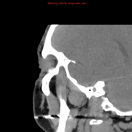 File:Blowout fracture with inferior rectus entrapment (Radiopaedia 12418-12673 C 2).jpg