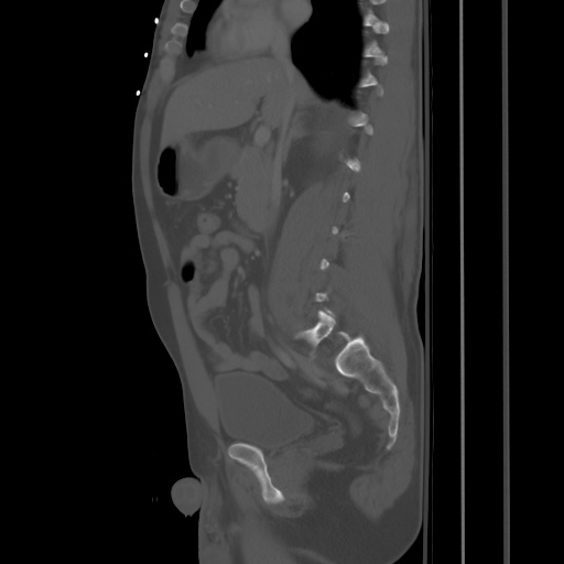 Blunt abdominal trauma with solid organ and musculoskelatal injury with active extravasation (Radiopaedia 68364-77895 Sagittal bone window 41).jpg