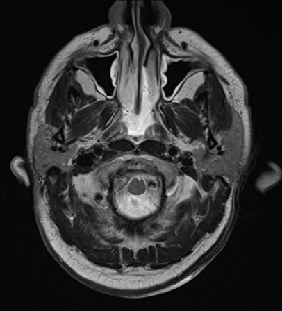 File:Blunt cerebrovascular injury (Radiopaedia 53682-59745 Axial T2 3).png