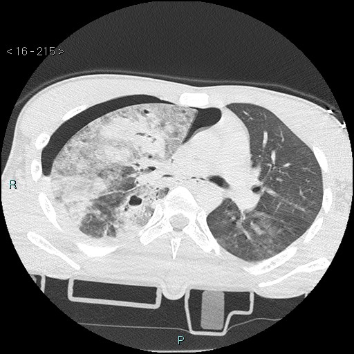 Blunt chest trauma (Swiss cheese sign) (Radiopaedia 38519-40618 Axial lung window 29).jpg